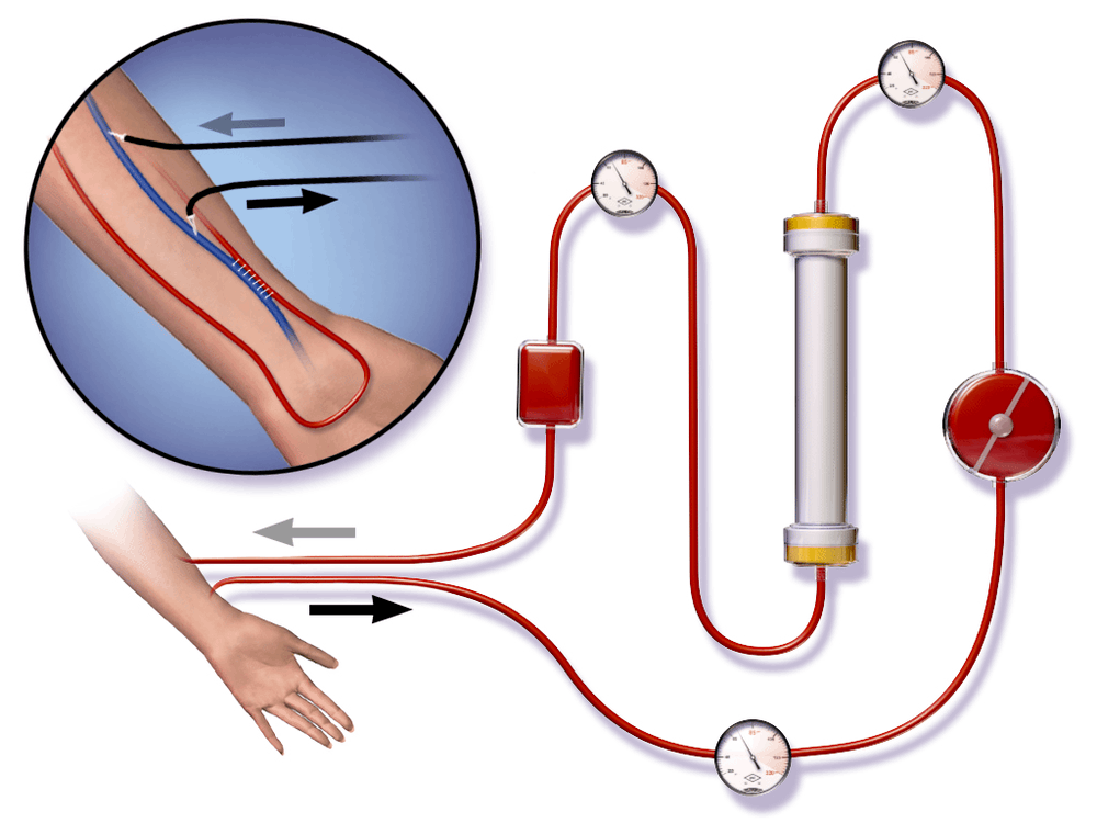 Kidney Dialysis